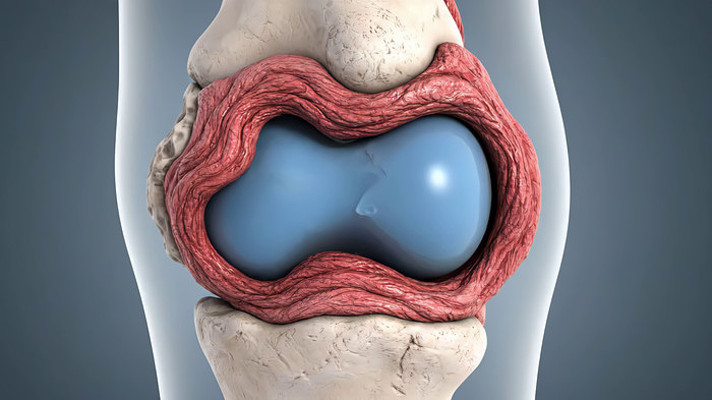 3D膝关节坏死解剖结构展示 3D膝关节坏死解剖结构展示