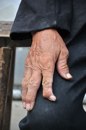 关节变形了的右手